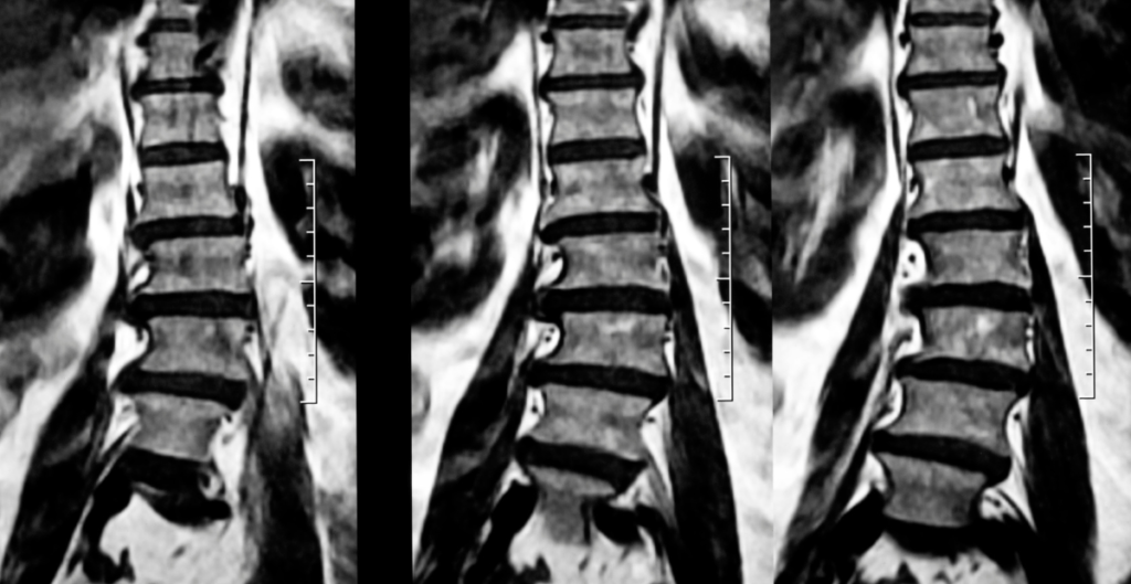 Diagnosis to Get Help of Scoliosis Chiropractor