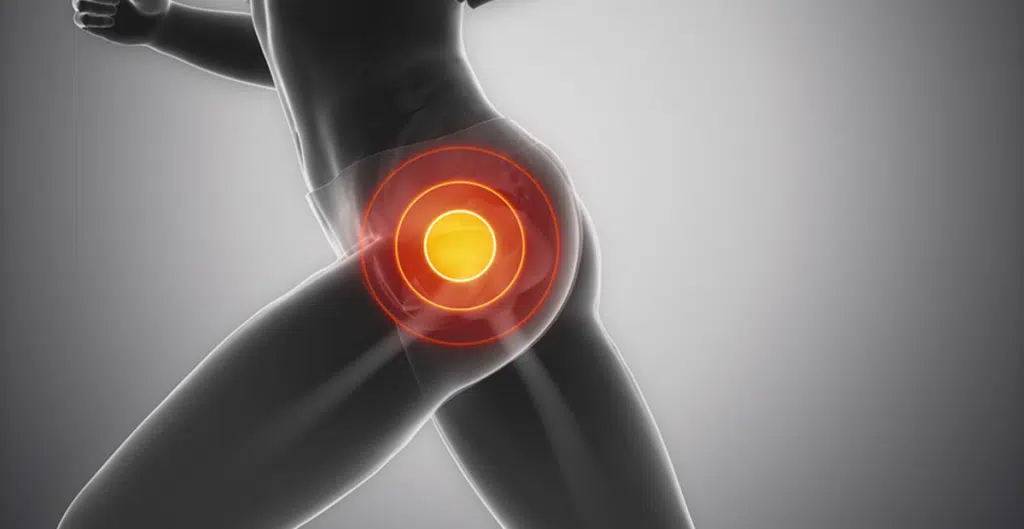 Can a Chiropractor Help with Hip Bursitis?