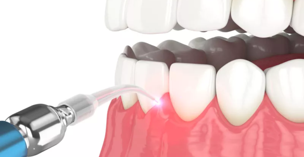 Laser Treatment for Gum Disease: Pros and Cons 