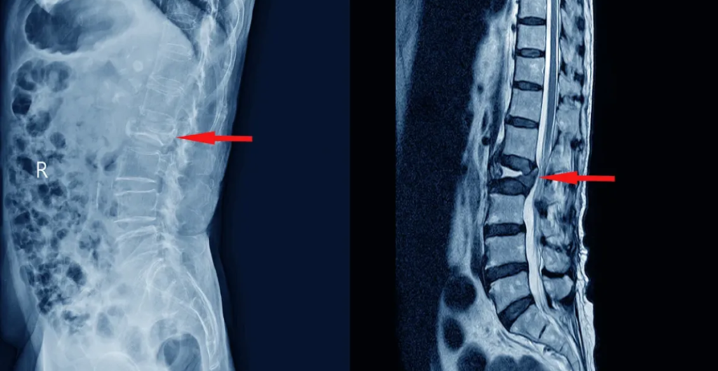 How Bulging Discs Affect the Body