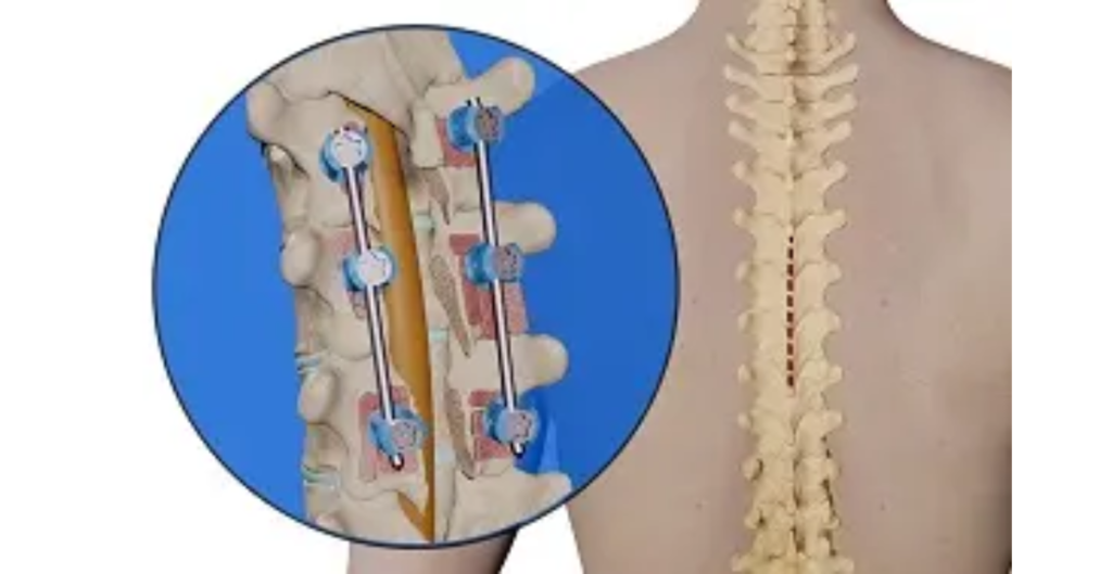 Can You Go to a Chiropractor with Rods in Your Back? 