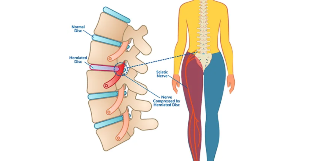 Herniated Discs 