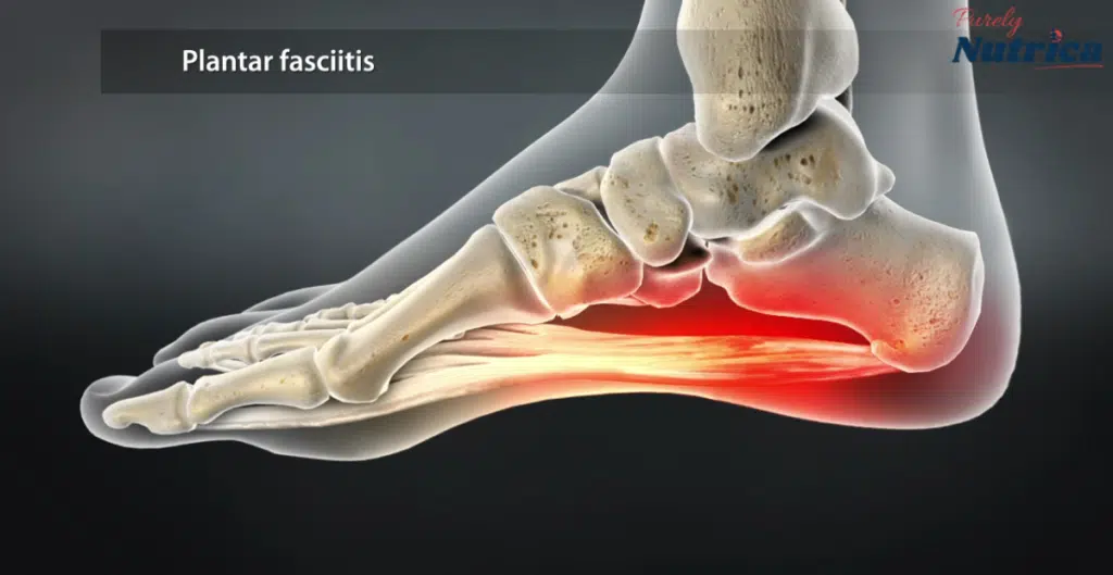 Can a Chiropractor Help with Plantar Fasciitis?