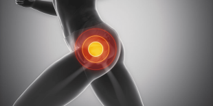 Can a Chiropractor Help with Hip Bursitis?