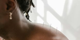 Acupuncture